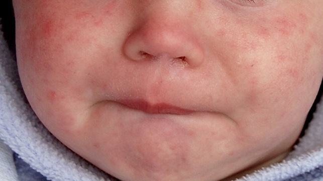 Suman 81 casos de sarampión; la mayoría no fueron vacunados