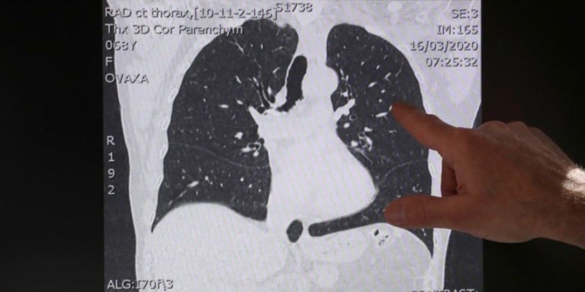 Covid-19 podría ocasionar deterioro pulmonar