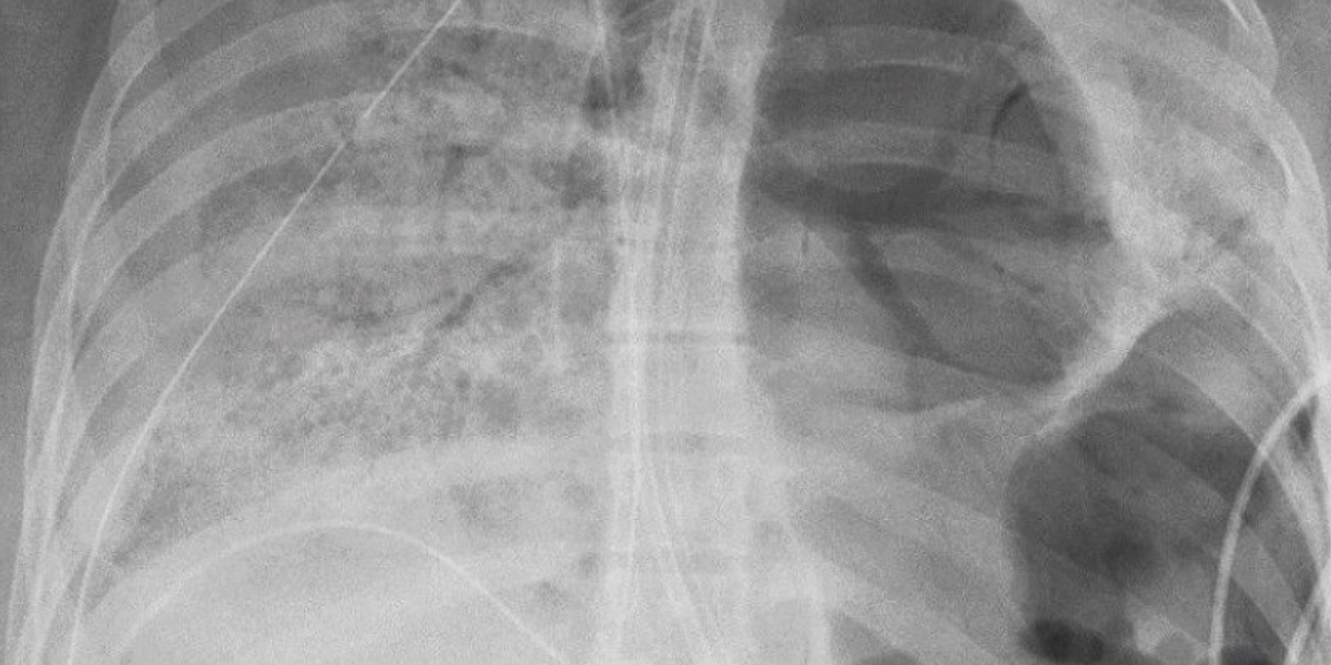 Trasplantan dos pulmones a una joven afectada por Covid-19