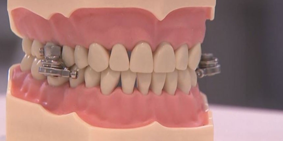 Crean ‘candado’ dental para combatir obesidad