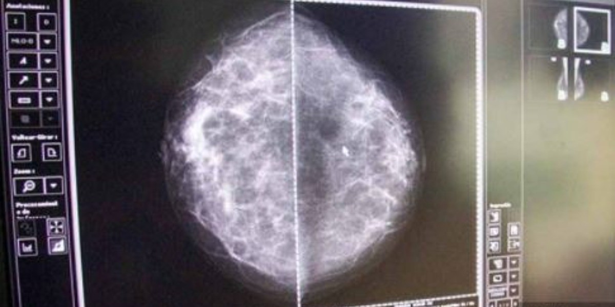 Casi un millón de guanajuatenses candidatas a tamizaje para detectar cáncer de mama