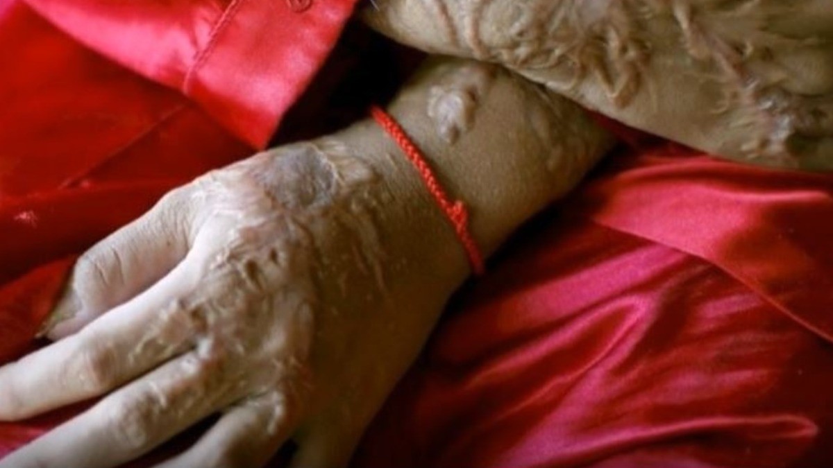 Piden diputadas que se considere uso de ácido como agravante de violencia