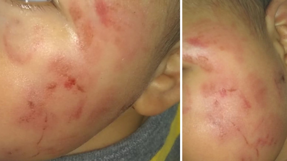 Mamá denuncia que le entregaron a su hijo con lesiones en Estancia Infantil Maravillas