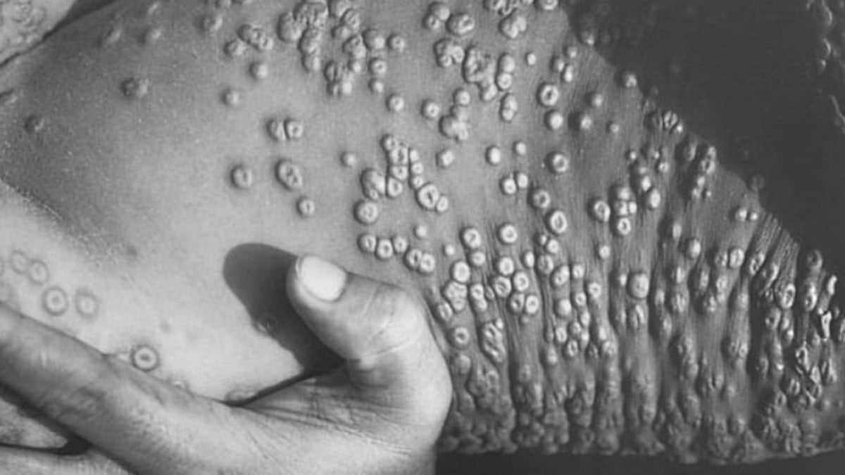 Alertan sobre llegada de la viruela del mono a México