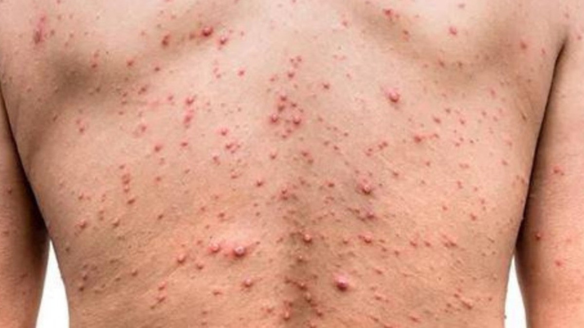 Patógeno de viruela del mono se ‘fortalece’, alerta estudio