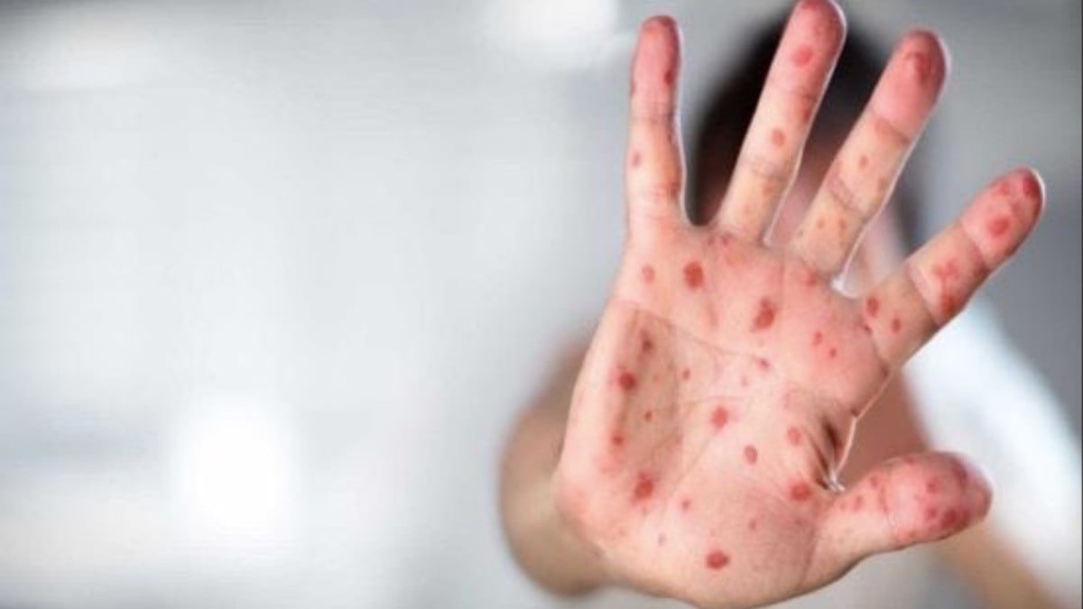 ¿Qué es la fiebre del tomate? El nuevo virus que se encuentra en vigilancia