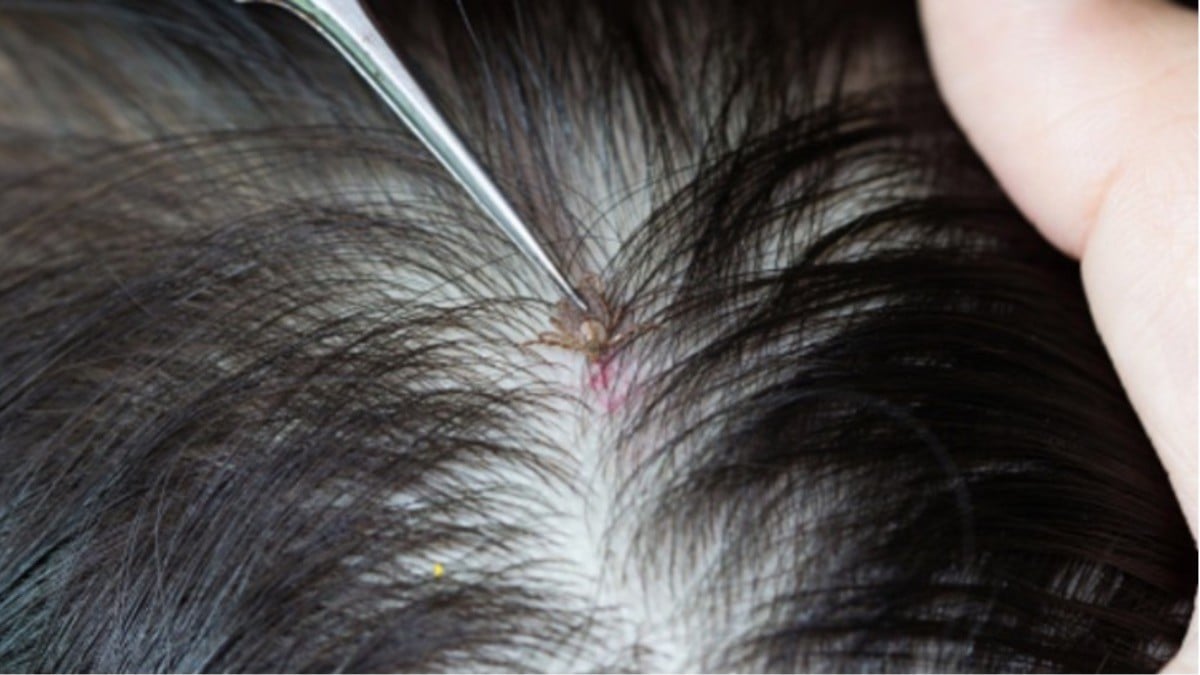 ¡La matan los piojos!