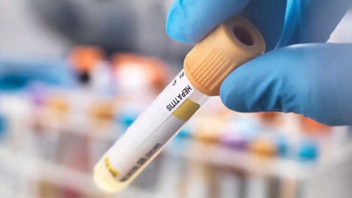 Analiza SSG posible caso de hepatitis aguda en niña de siete años