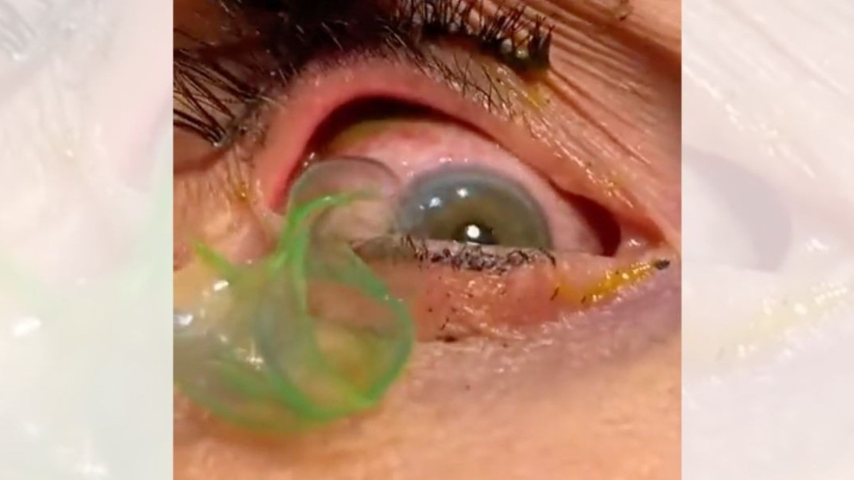 #VIDEO ¡Sacan 23 lentes de contacto del ojo de una mujer!