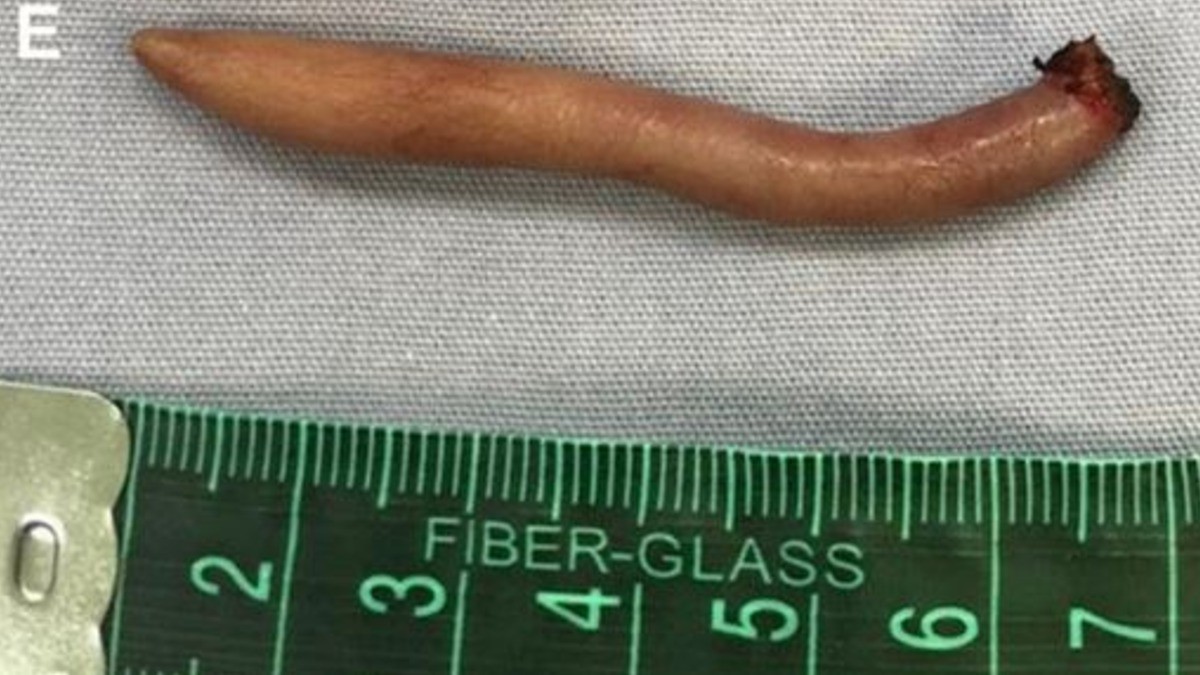 Es real, ¡nace una bebé con cola en Nuevo León!