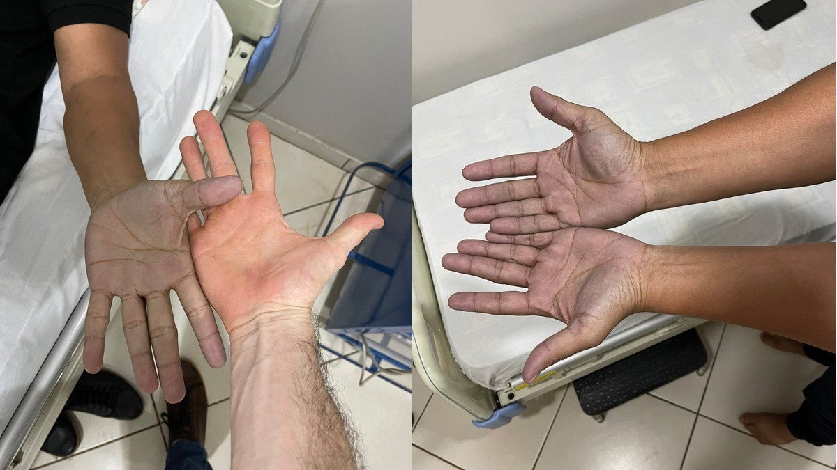 Paciente acude al doctor por extraña coloración en las manos; ¡se había manchado con el pantalón!