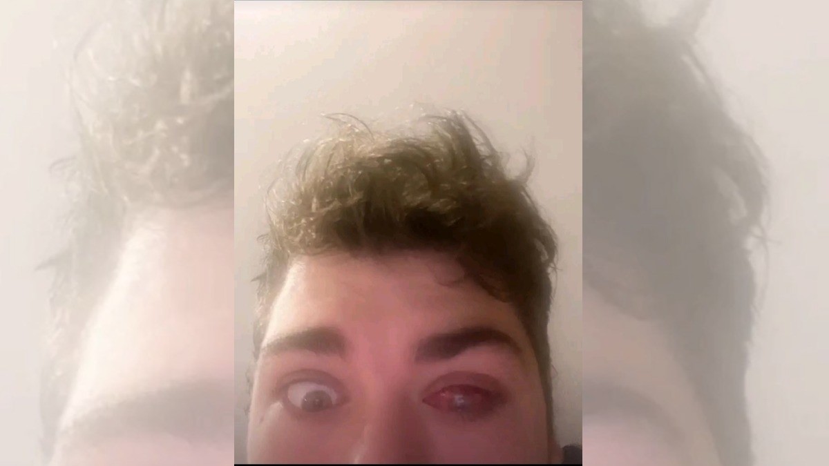 Hombre se queda dormido con lentes de contacto, ¡y pierde la vista!