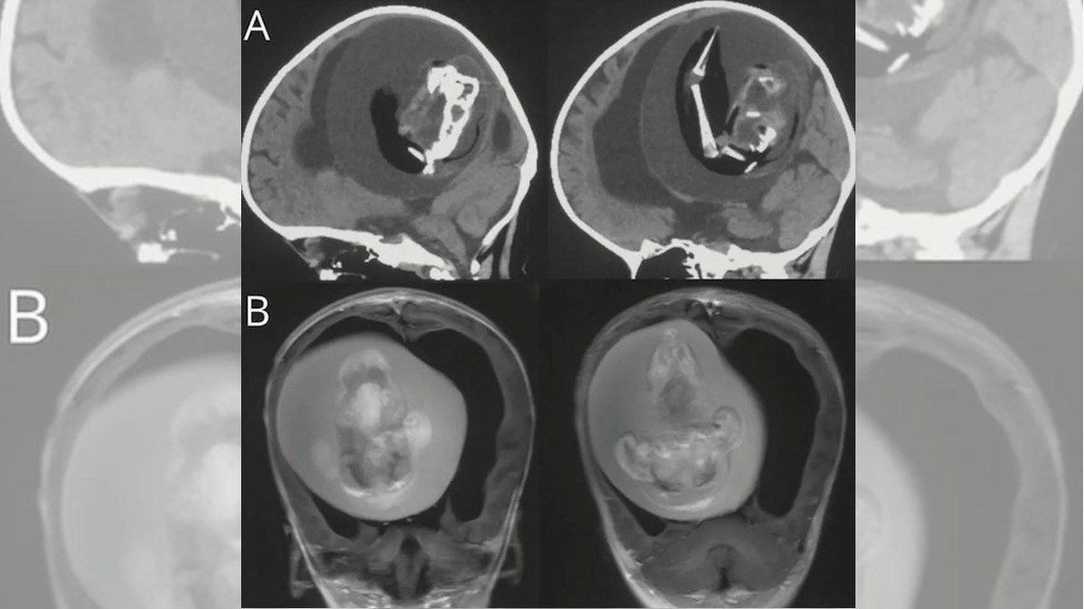 ¡Bebé de un año albergaba un “gemelo parásito” en su cerebro!
