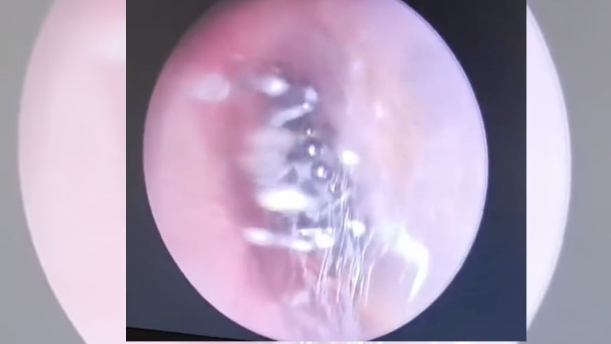 Acude al doctor por malestar en el oído; ¡le encuentran una araña!