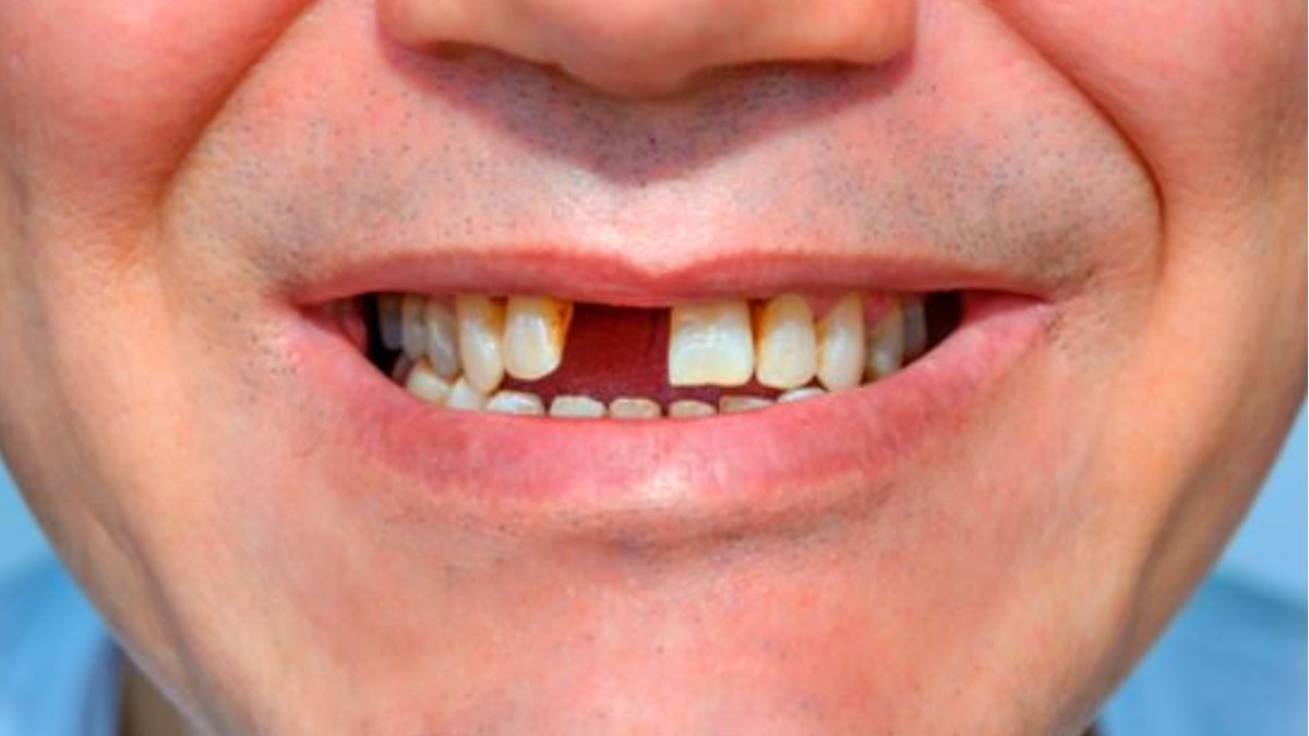 Científicos buscan crear dientes que crezcan ¡solo con medicamento!