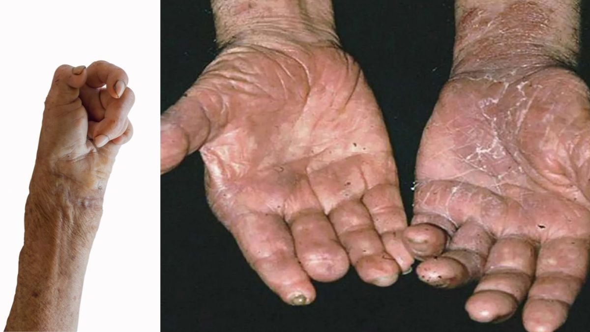 Lepra en México: vigilan casos en 12 municipios