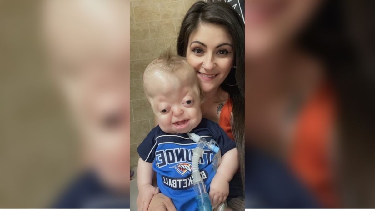 Bebé nace con un síndrome raro; se burlan de él y su mamá ruega que no lo juzguen