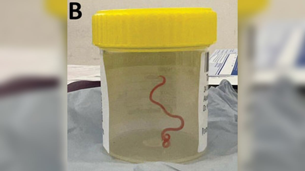 Doctores encuentran un gusano vivo en el cerebro de una mujer; ella sobrevive