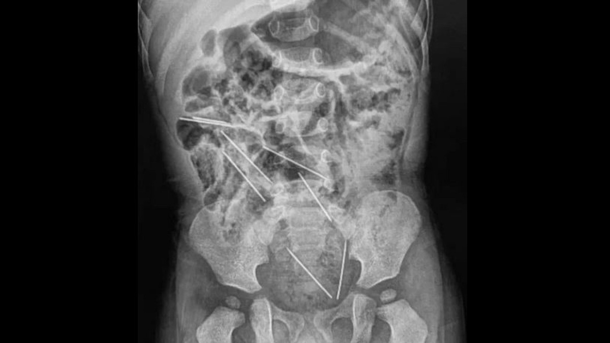 Niño 'faquir' de dos años traga ocho agujas y ¡sobrevive!