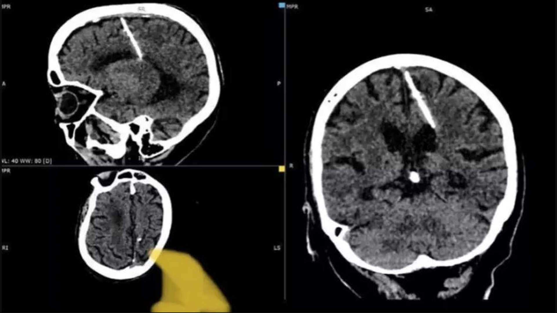 Mujer lleva 80 años con una aguja en el cerebro; sospechan que trataron de matarla de bebé