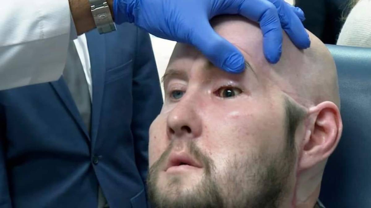 ¡Histórico! Realizan el primer trasplante de un ojo completo