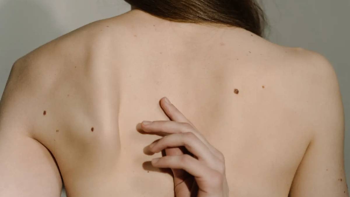 ¡Cuidado! Estos son los lugares donde aparecen más lunares cancerígenos