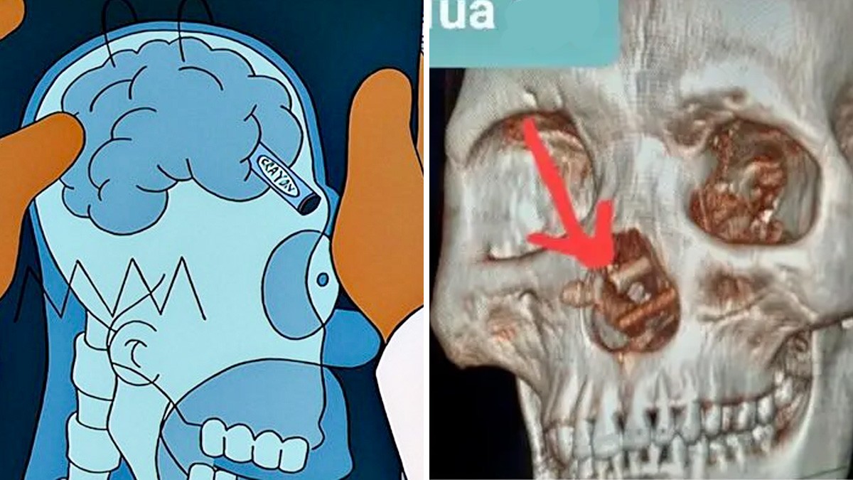 ¿Eres tú, Homero? Hombre tuvo palillos incrustrados en su cerebro por 5 meses