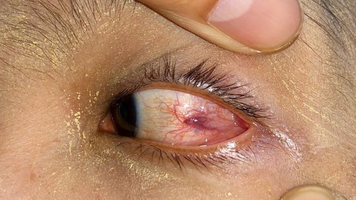 ¡Mujer tenía 60 gusanos viviendo en sus ojos!