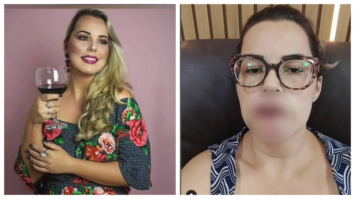 Influencer se queda sin labios tras someterse a tratamiento estético