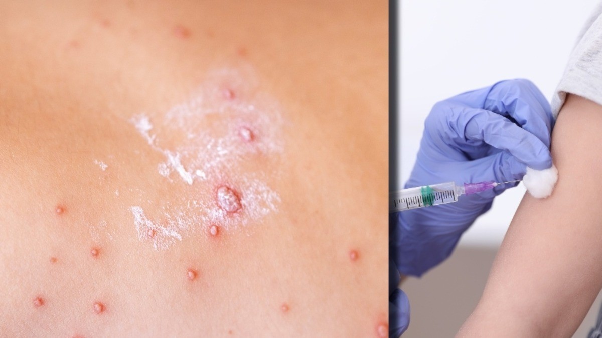 Reportan caso de sarampión importado a México