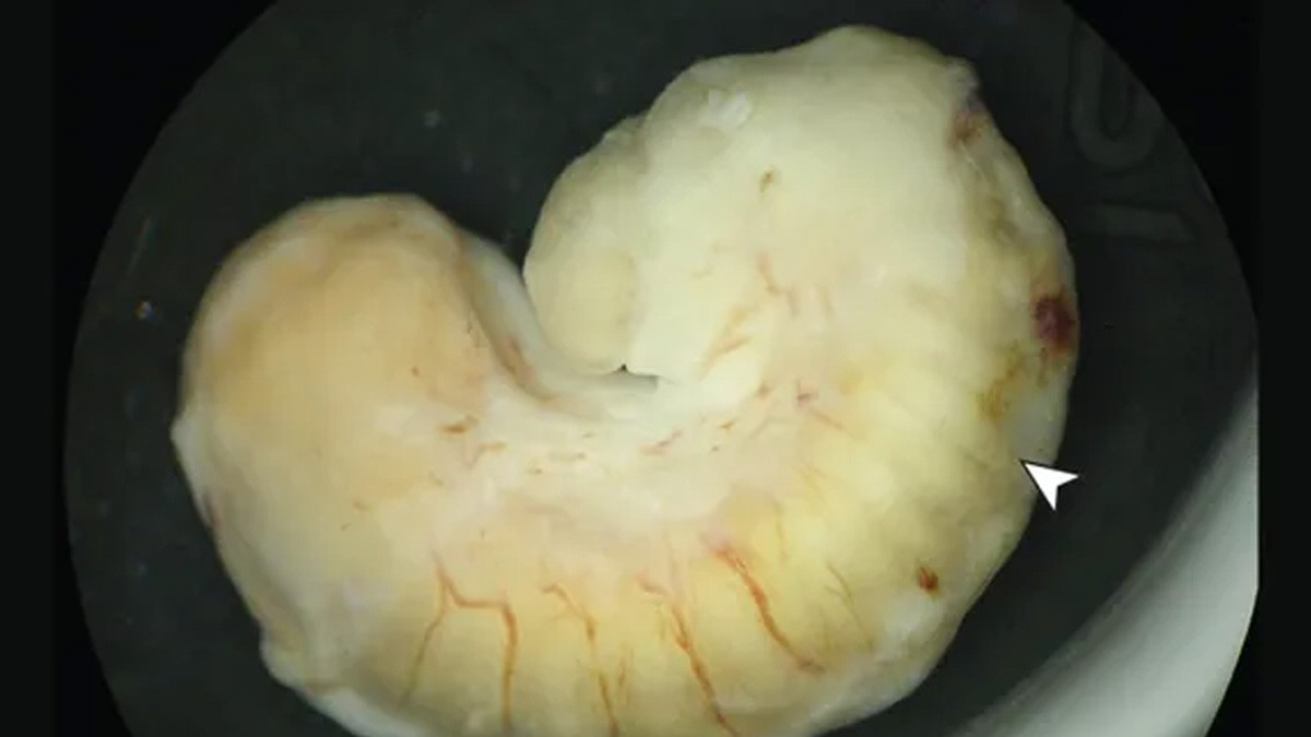 Mujer siente bulto en el ojo y va al doctor; ¡tenía un gusano vivo!