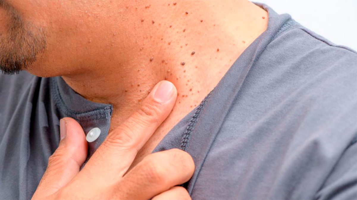 ¿Por qué salen verrugas en el cuello?, conoce tres problemas de salud que las originan