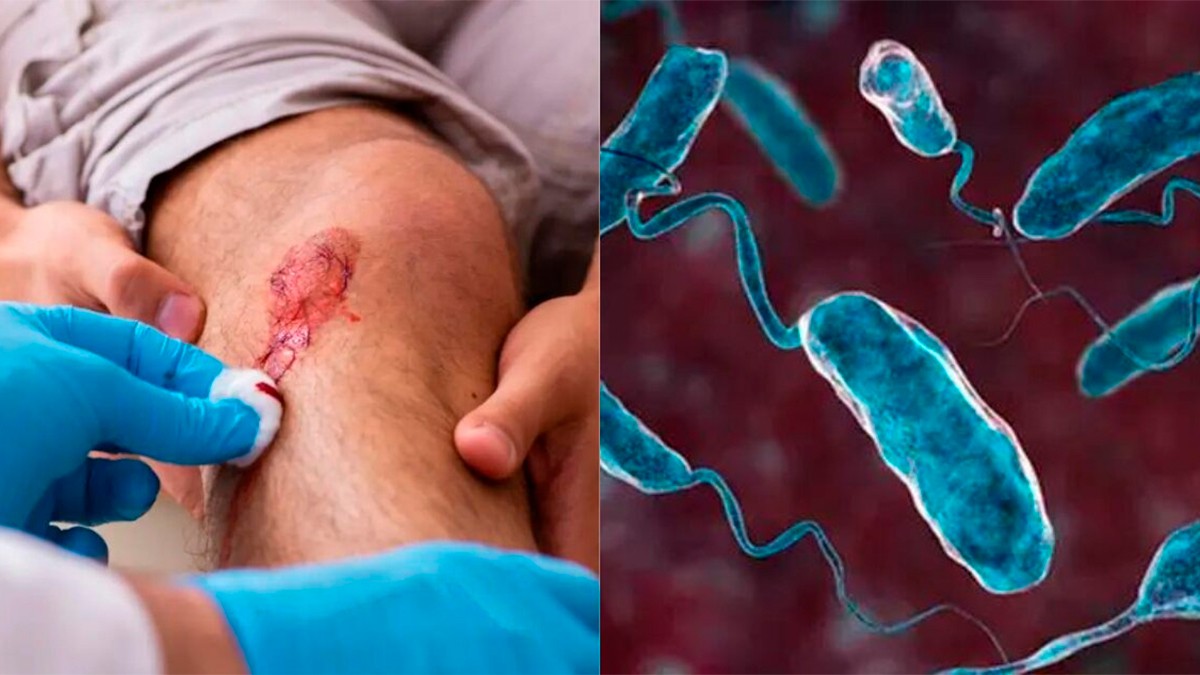 ¡Alerta! Bacteria carnívora mata en dos días a personas de este país