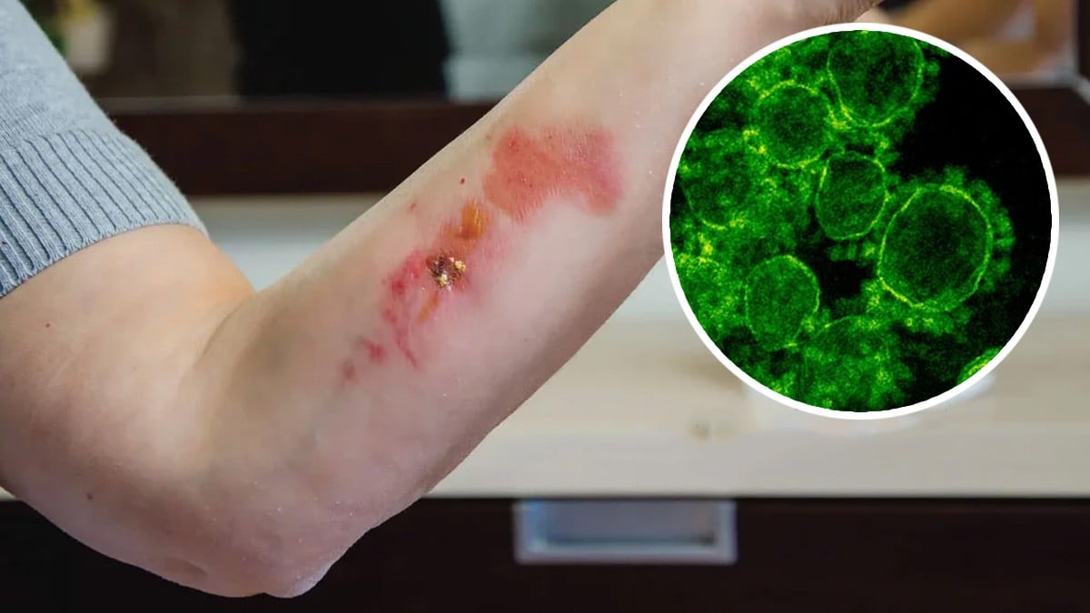 ¿Cuáles son los síntomas que causa la bacteria carnívora que acecha a humanos?