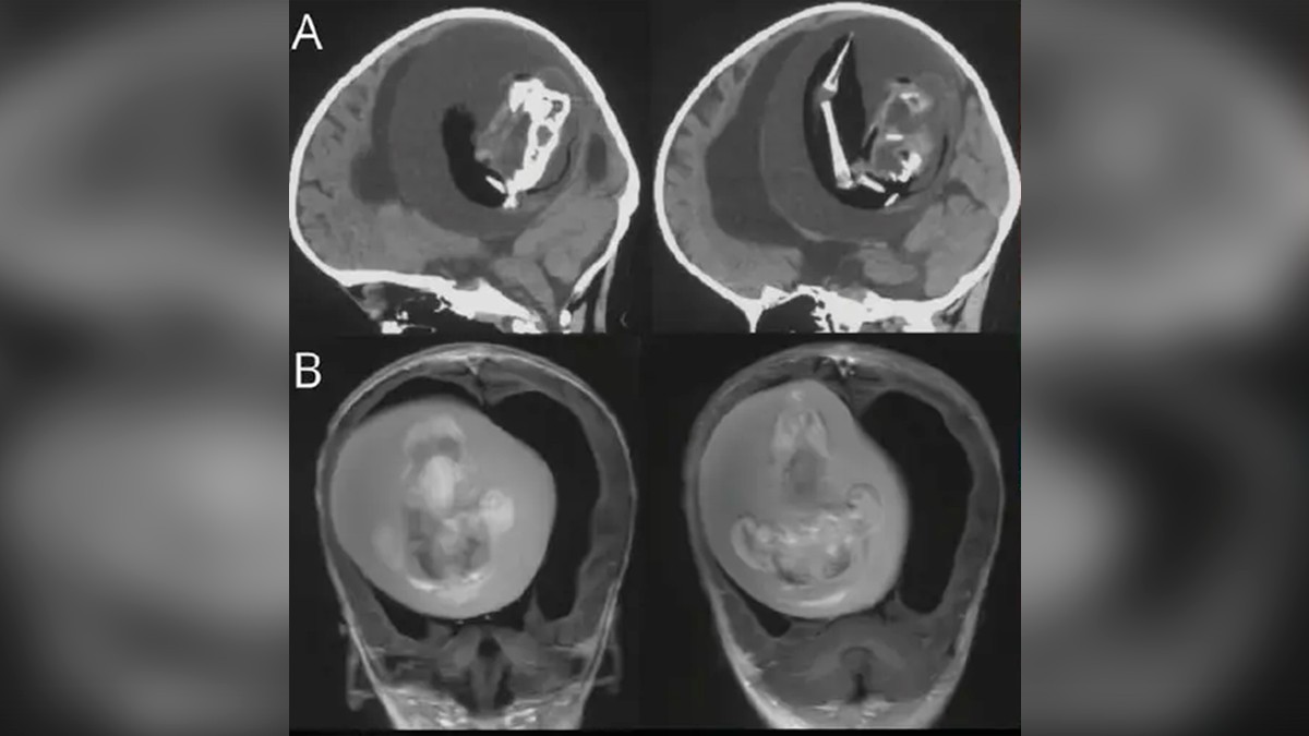 ¡Sorprendente! Doctores encuentran un feto dentro del cráneo de una bebé de 1 año