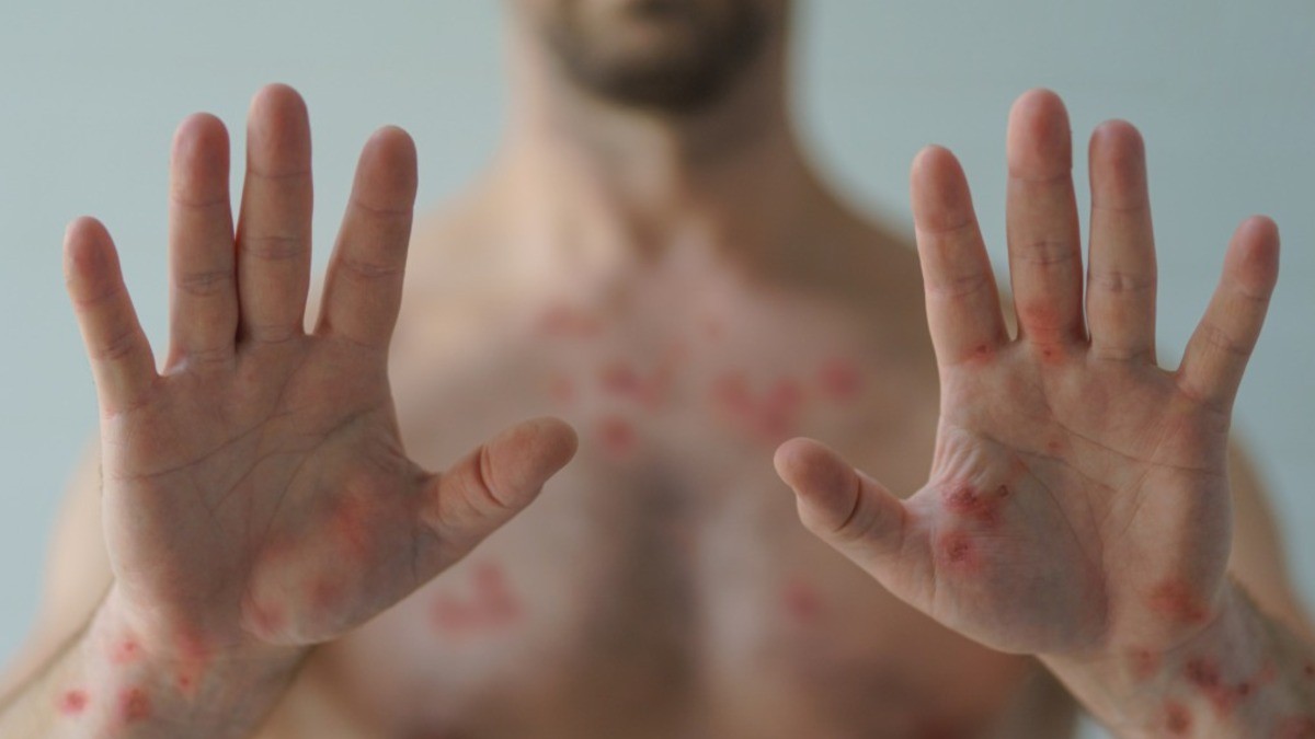 ¿Otra pandemia? OMS declara alerta mundial por mpox, es una grave enfermedad