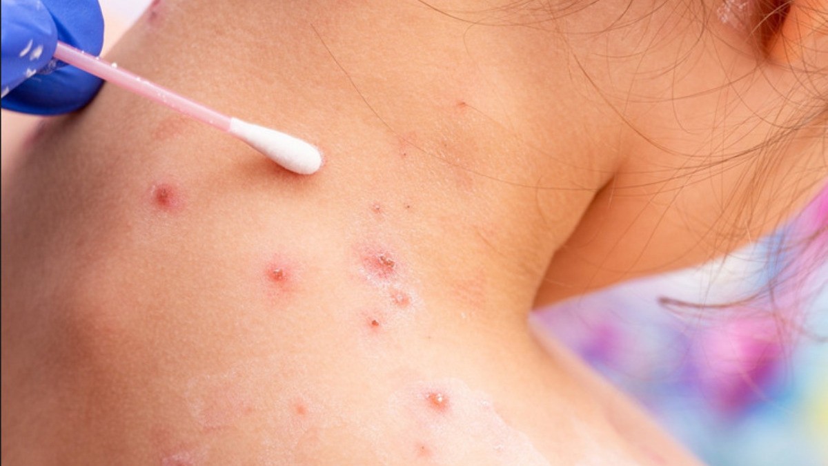 México confirma 49 casos de viruela del mono; estos son los síntomas