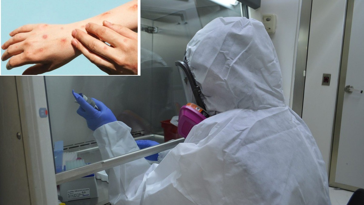 Guanajuato 'se pone las pilas' contra la viruela del mono