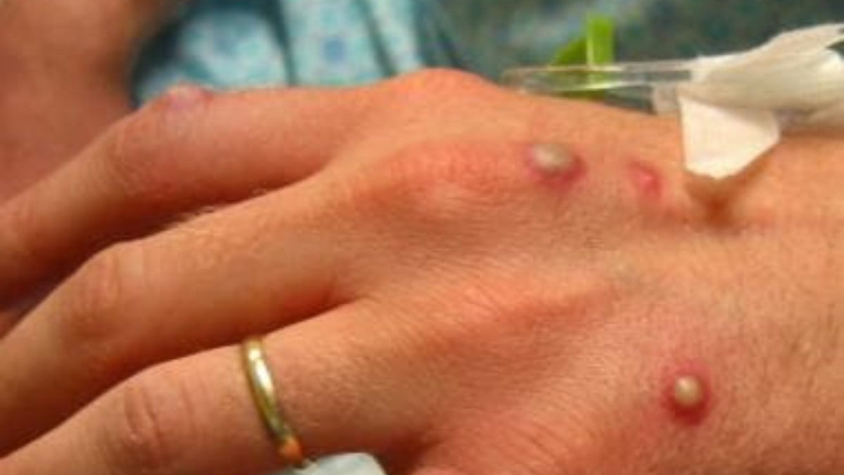 Hay 53 casos de viruela del mono en el país; estos son los estados afectados