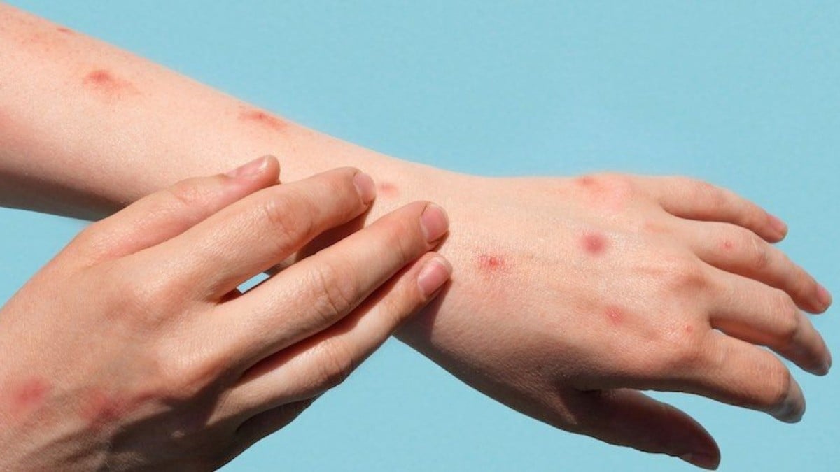 ¿Sabes cómo se contagia la viruela del mono? Toma medidas y cuida a tu familia