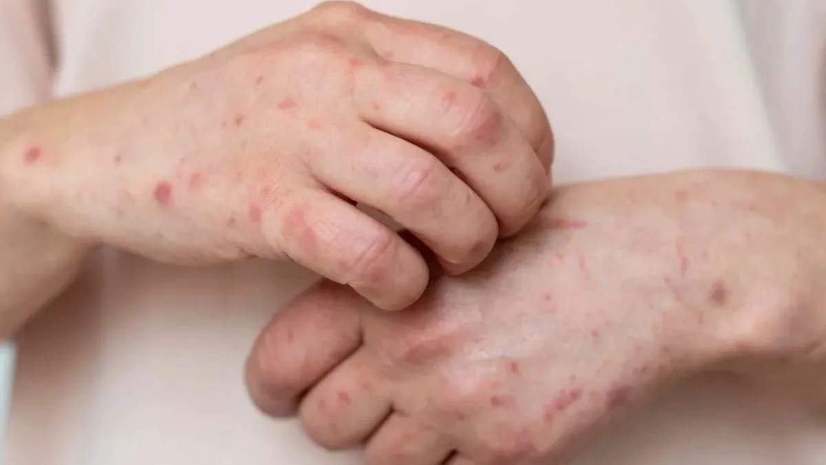 ¡Alerta! Paciente con viruela del mono escapa de hospital y se va en transporte público