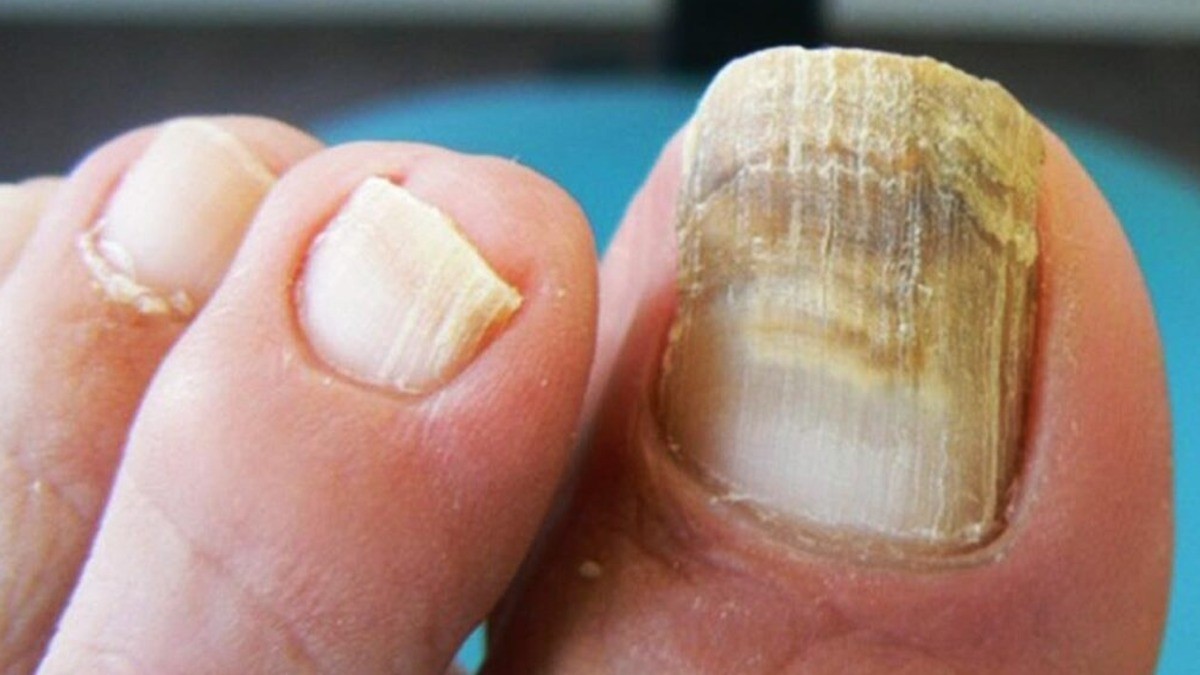 ¡No más hongos! Así puedes curar las uñas de tus pies con remedios caseros