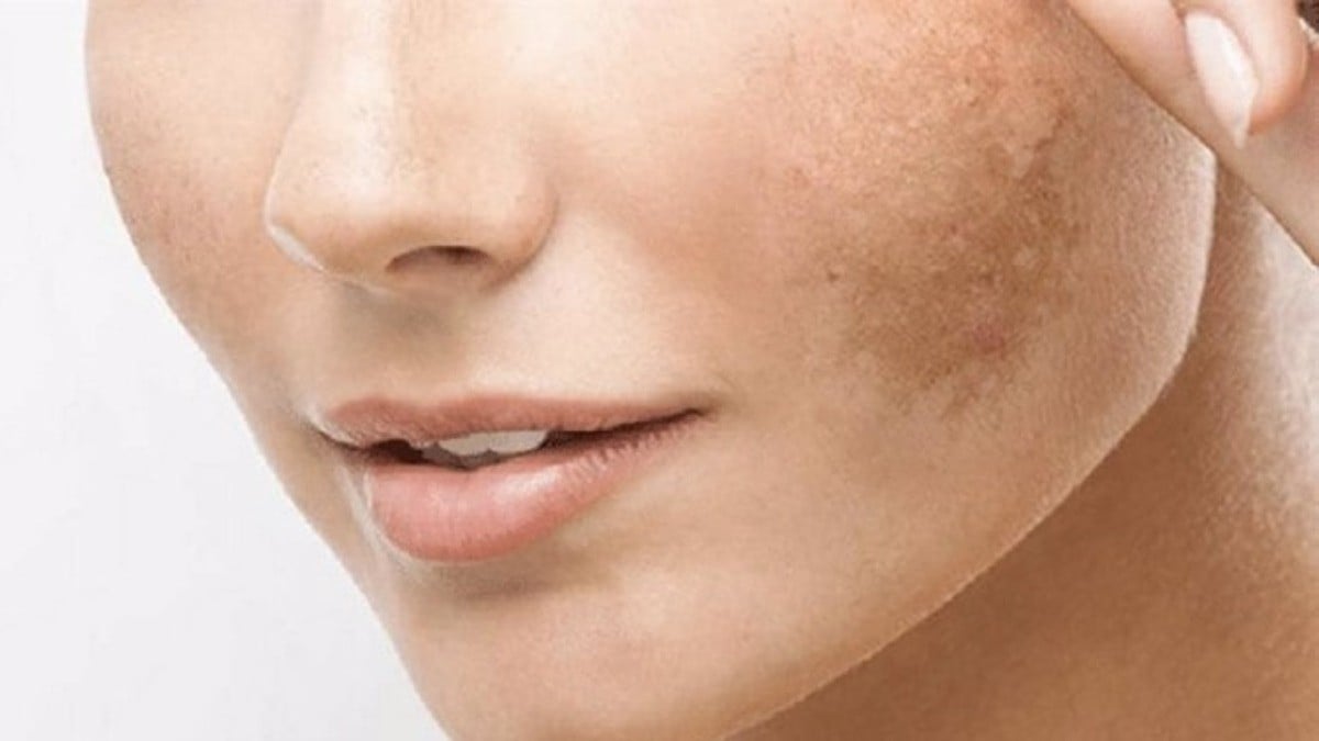 ¿Manchas en la cara? Combátelas con las sustancias más eficaces, según expertos