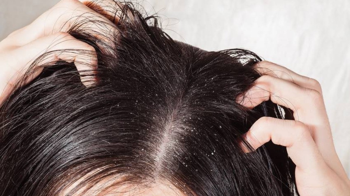 ¿Hongos en la cabeza? Despídete de la caspa con este efectivo remedio casero