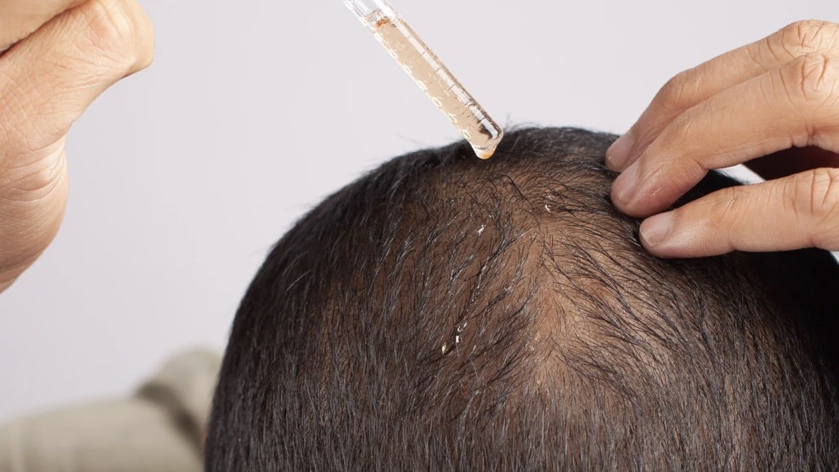 Minoxidil y el 'síndrome del hombre lobo', riesgo de efectos secundarios en bebés