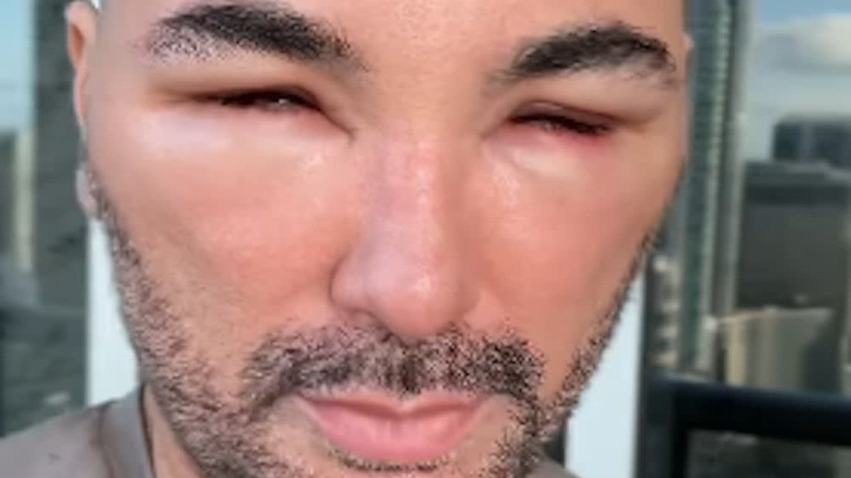 Alarma famoso actor mexicano al aparecer con el rostro desfigurado, ¿qué le pasó?