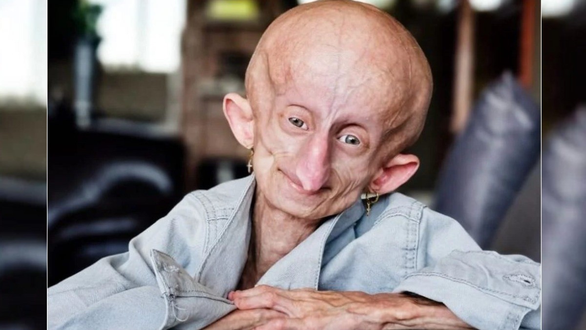 Fallece famosa tiktoker Beandri Booysen tras vivir 19 años con esta extraña enfermedad