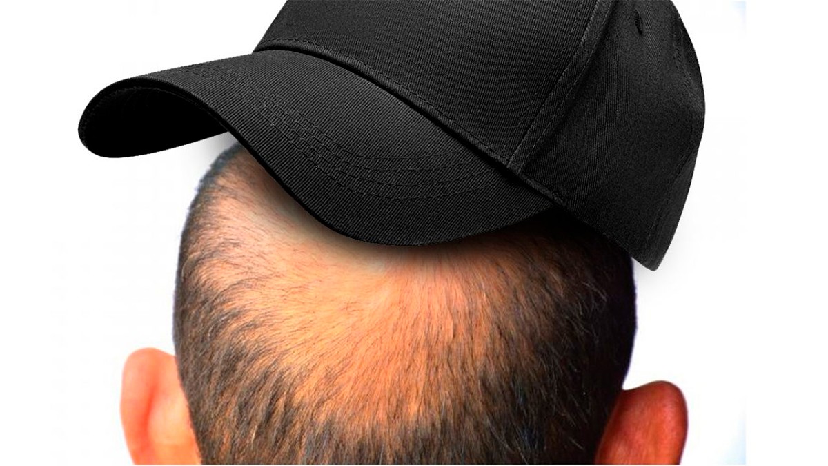 VIDEO ¿Usar gorra puede causar calvicie? Un experto resuelve el mito