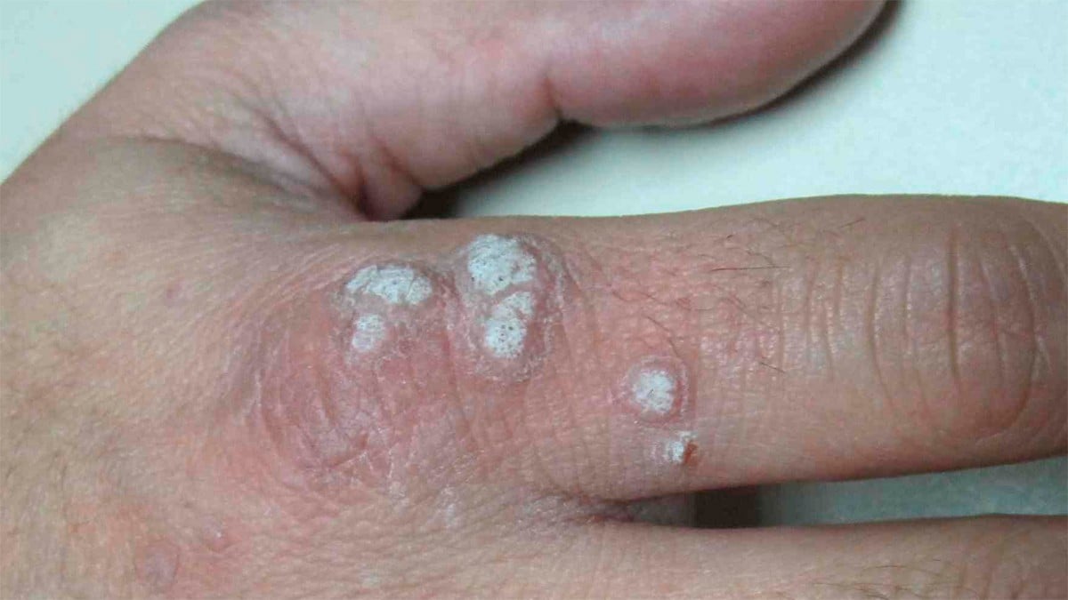 Científica mexicana es reconocida por lograr erradicar el Virus del Papiloma Humano