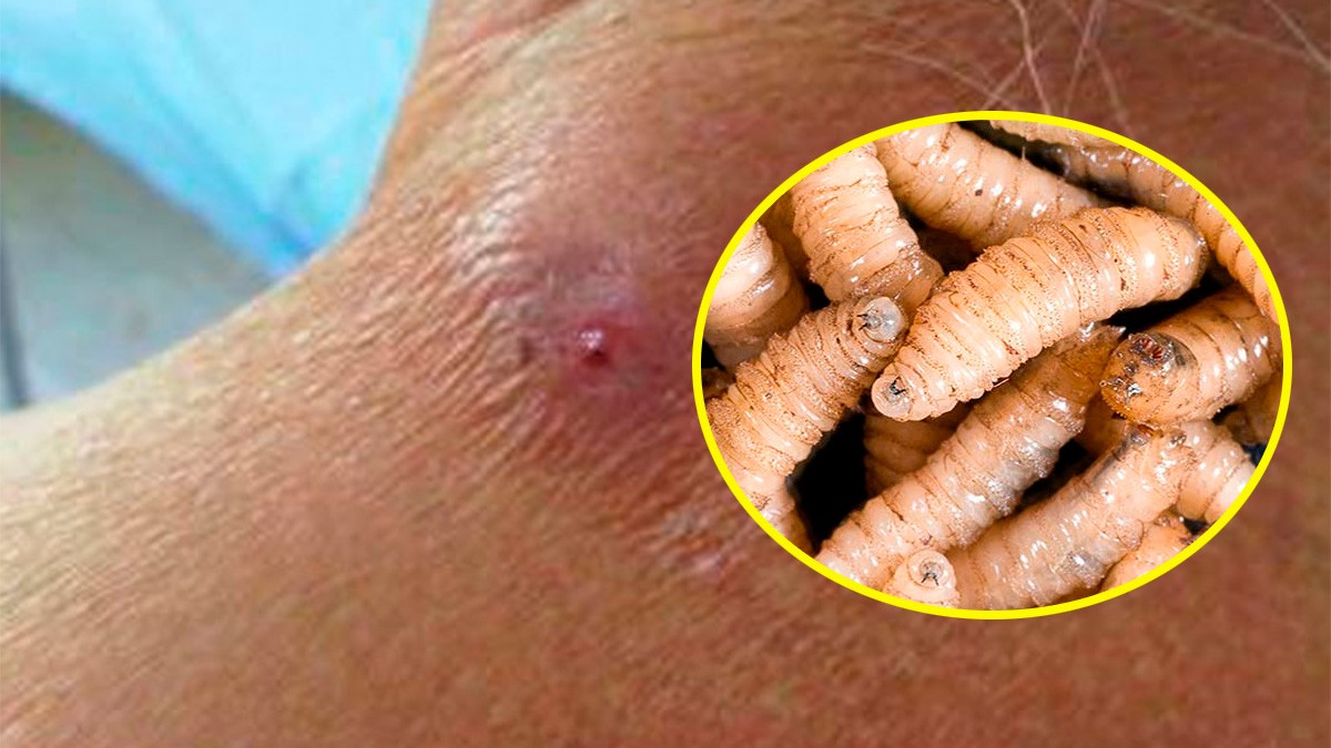 Confirman un nuevo caso de gusano barrenador en humanos y lanzan alerta de salud